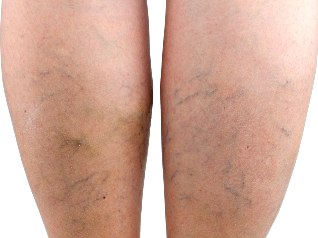 Spider Vein Treatment