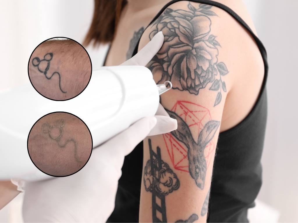Laser Tattoo Removal